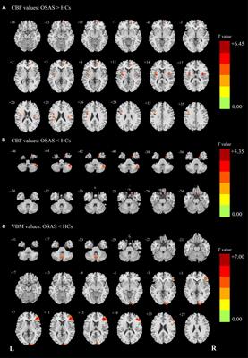 Abnormal Cerebral Blood Flow and Volumetric Brain Morphometry in Patients With Obstructive Sleep Apnea